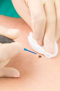 Eletrocoagulação - Dra. Luana Meneghello | Dermatologista